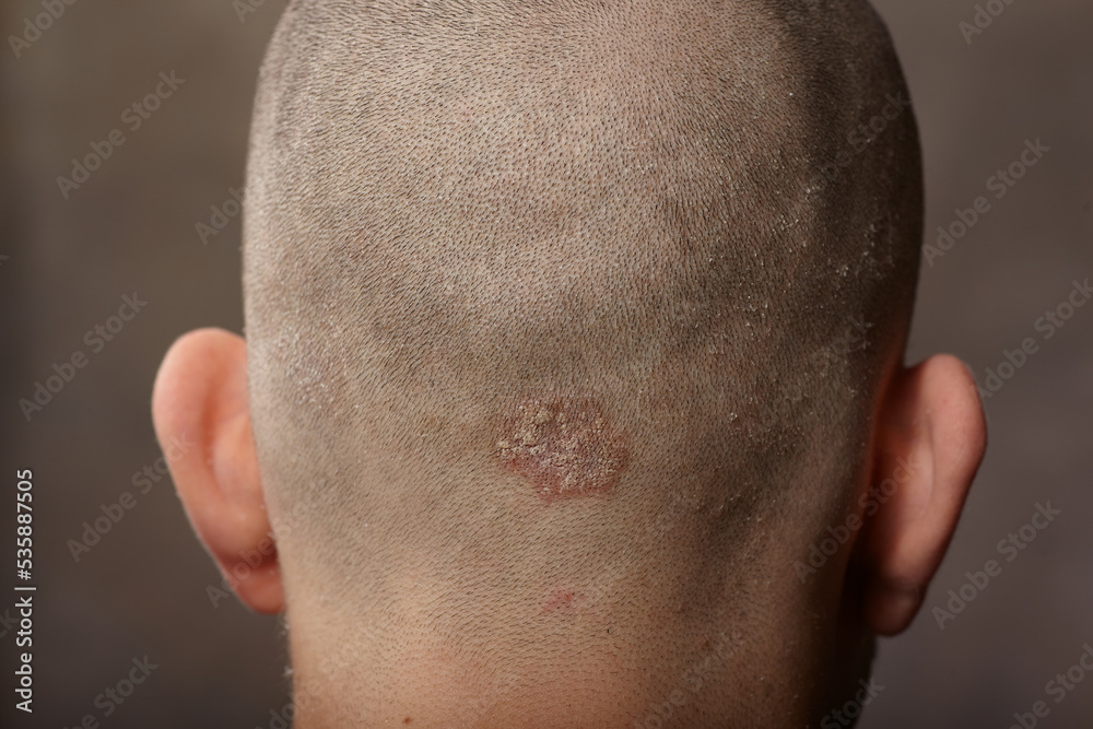 Fototapeta premium Eczema caucasian male head back