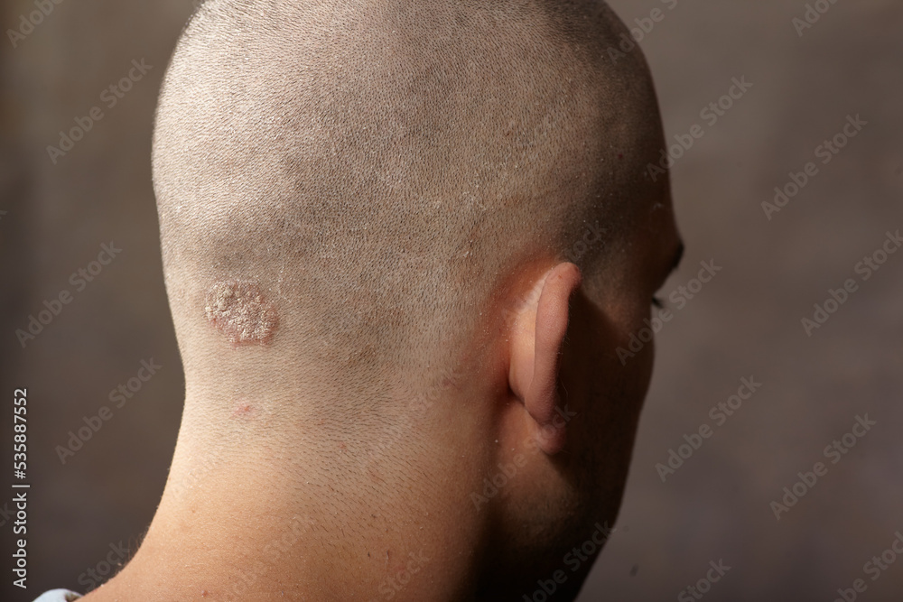 Naklejka premium Eczema caucasian male head back