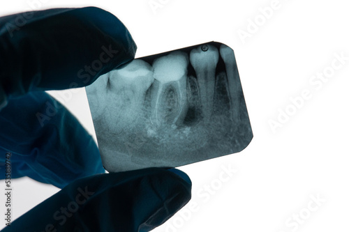 Periapical Dental Granuloma next to tooth root on an X-ray held by Dentist