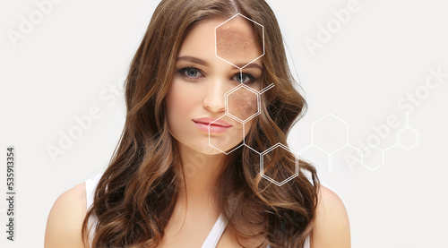 Tableau sur toile Dark spots, freckles,hyperpigmentation(melasma or chloasma),concept - skin light