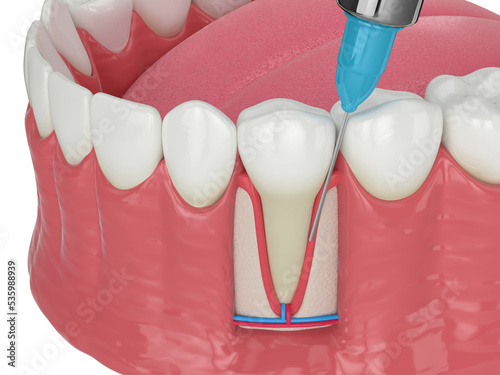 3d render of human jaw with intraligamentary anesthesia procedure photo