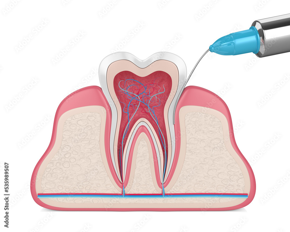 3d render of tooth in gums with intraligamentary anesthesia procedure ...