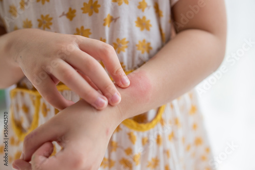 Foto Little girl has skin rash allergy itching and scratching on her arm