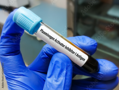 Blood sample for Plasminogen Activator Inhibitor 1 (PAI-1) Antigen test. photo