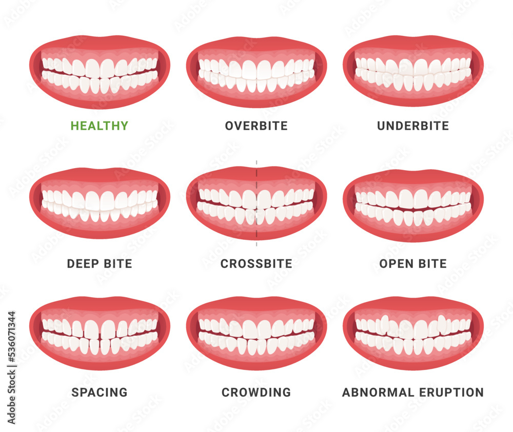Human Mouth Jaws Medical Bad Bite And Healthy Scheme With Names Set human-mouth-jaws-medical-bad-bite-and-healthy-scheme-with-names-set