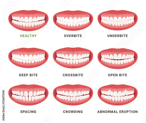 Human mouth jaws medical bad bite and healthy scheme with names set vector flat photo