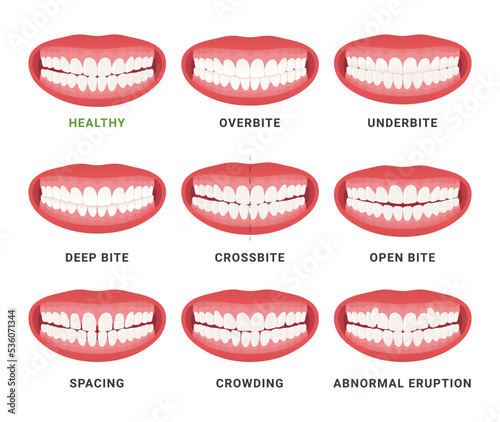 Human mouth jaws medical bad bite and healthy scheme with names set vector flat