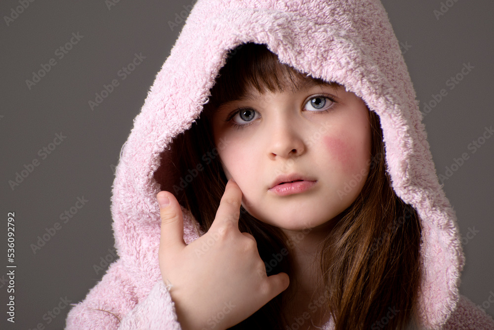 Food allergy in a young child on the cheeks , little girl has eczema on her face. Food allergy in a young child on the cheeks , little girl has eczema on her face.