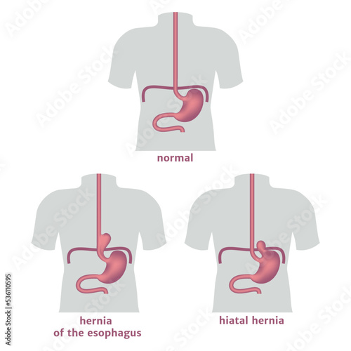 Torso with hernia of the stomach and esophagus. Medical poster. Vector illustration