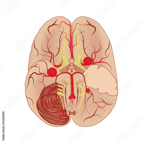 Cerebral aneurysms, ventral view. Medical poster. Vector illustration