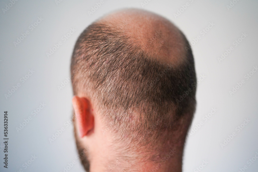 Bald head close-up. The problem of hair loss in men. Alopecia in men. Bald head close-up. The problem of hair loss in men. Alopecia in men.
