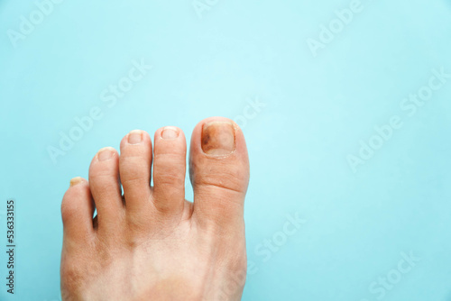 Problem nails close-up on a blue background. Nail disease.