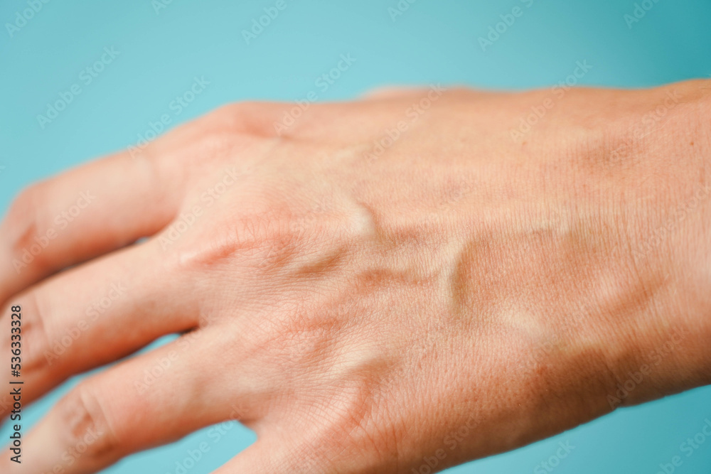 Fototapeta premium Protruding veins on female hands close-up. Surface arrangement of veins.