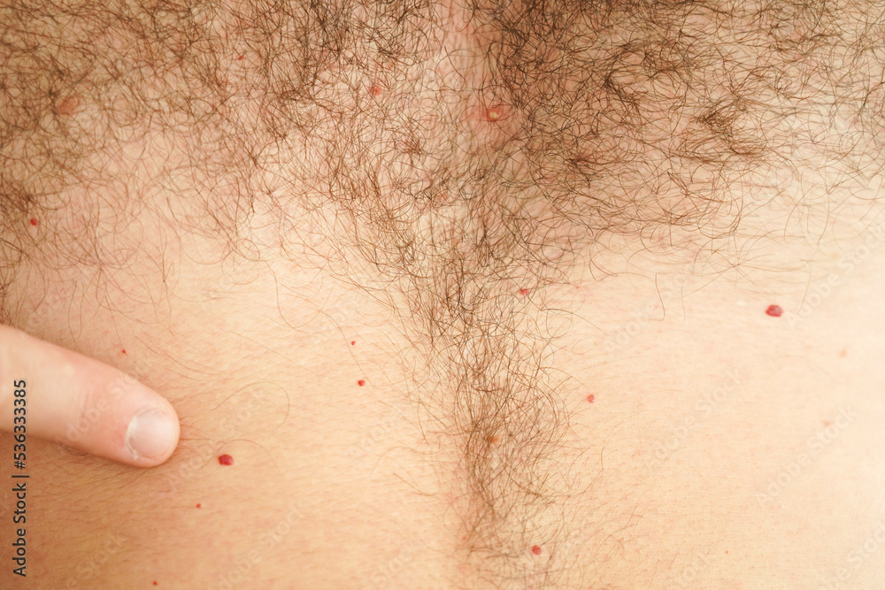 Fototapeta premium Close-up of a man's hairy chest. A pustule on the human body.