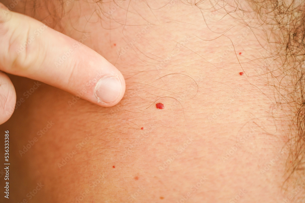 Fototapeta premium A red birthmark on a human body.
