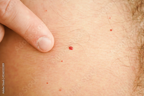 A red birthmark on a human body. photo