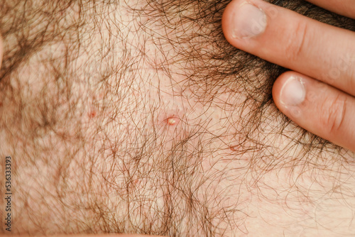 Close-up of a man's hairy chest. A pustule on the human body. photo