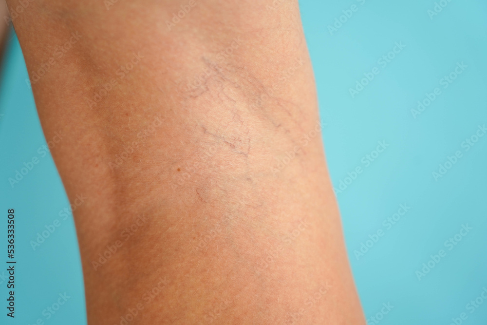 Vascular network on the human body. Telangiectasias on the skin. Vascular network on the human body. Telangiectasias on the skin.