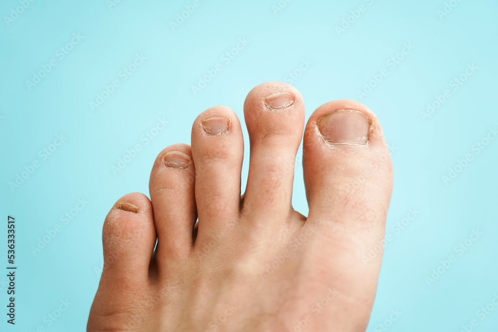 Male toes close-up. Lack of pedicure, unkempt nails. Male toes close-up. Lack of pedicure, unkempt nails.