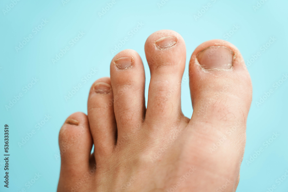 Male toes close-up. Lack of pedicure, unkempt nails. Male toes close-up. Lack of pedicure, unkempt nails.