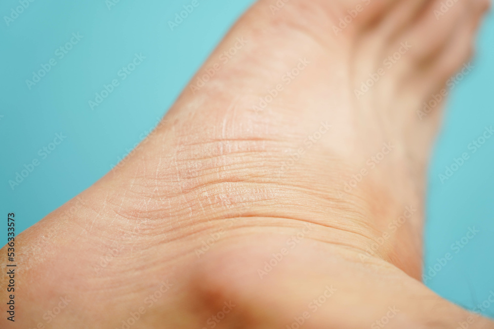 Dry skin on the leg close-up. Dry skin problem. Dry skin on the leg close-up. Dry skin problem.