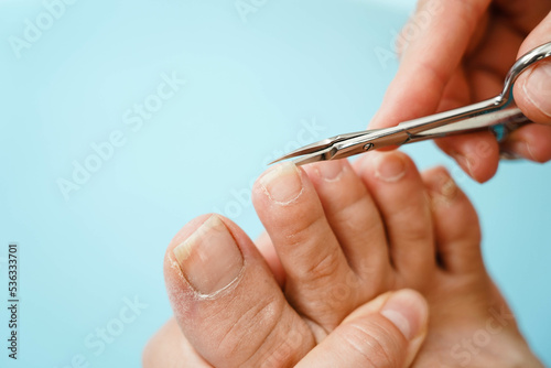 Close-up of problematic nails. Nail disease. The process of performing a pedicure with nail clippers.