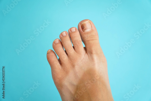 Obraz na plátne Problem nails close-up on a blue background. Nail disease.