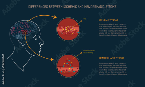 Differences between ischemic and hemorrhagic stroke. Brain silhouette and infographic of the two types of stroke on blue background.