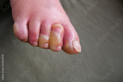 Close up of water blisters on the toes of paraplegic after serious hot water burn photo