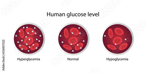 Human glucose level. Hyperglycemia, normal and hypoglycemia levels.