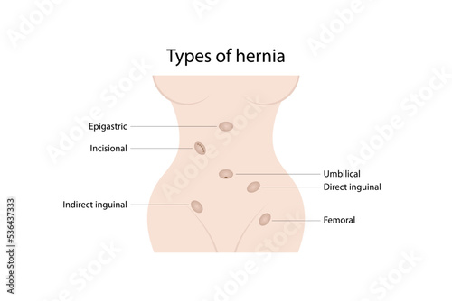 Types of hernia. Epigastric, incisional, direct inguinal, indirect inguinal, umbilical, femoral hernias. photo