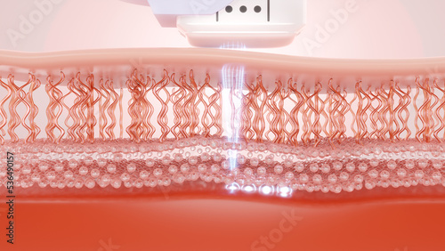 Fototapeta Naklejka Na Ścianę i Meble -  HIFU laser treatment shot laser deep to SMAS to enhancing the radiance, firmness and suppleness of skin. 3D rendering.