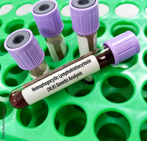 Foto Blood sample for hemophagocytic lymphohistiocytosis(HLH) genetic analysis, HLH is a potentially fatal disease characterized by abnormal activation of T-lymphocytes and macrophages