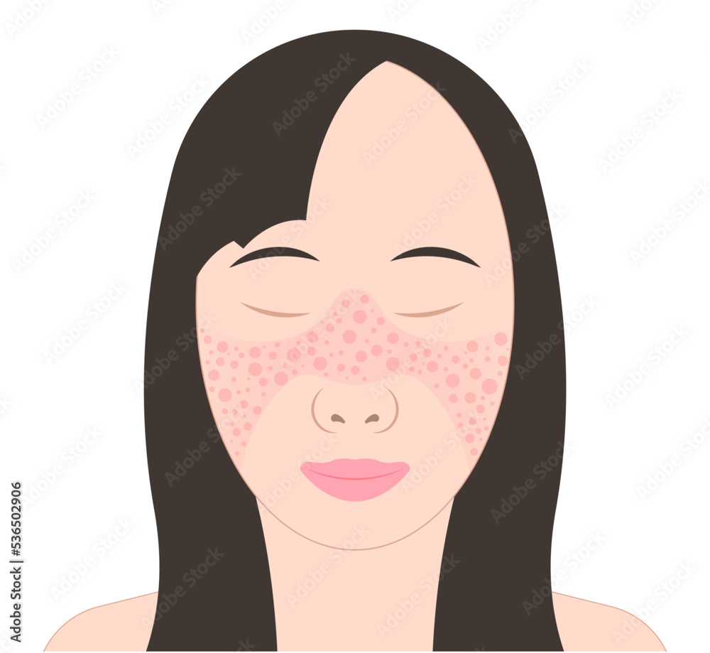butterfly and malar rash on facial with chronic joint Pain inflammatory hair loss kidney failure