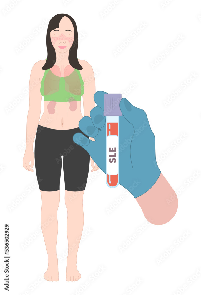 chronic inflammatory disease and joint facial Pain butterfly and malar