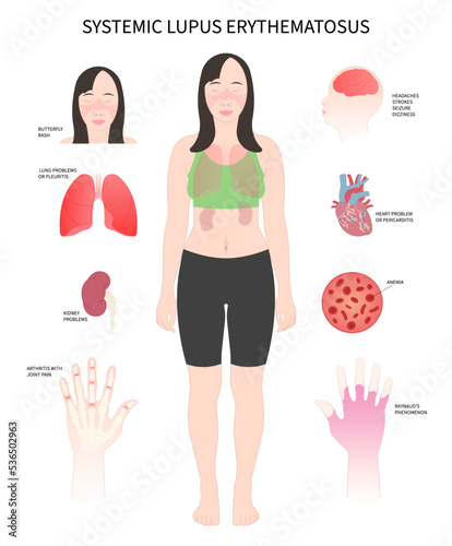 chronic inflammatory disease and joint facial Pain butterfly and malar rash hair loss kidney failure of Raynaud face purple or pale
