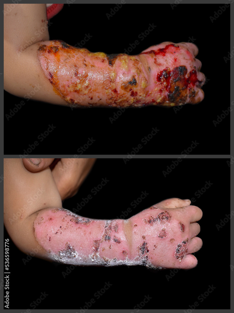 Before and after treatment of scald burn wound in hand and forearm of Asian baby. Stock Photo