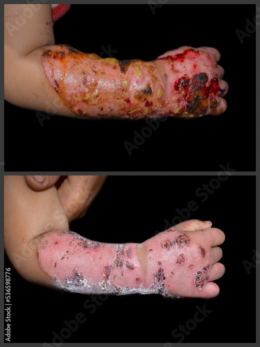 Before and after treatment of scald burn wound in hand and forearm of Asian baby. photo