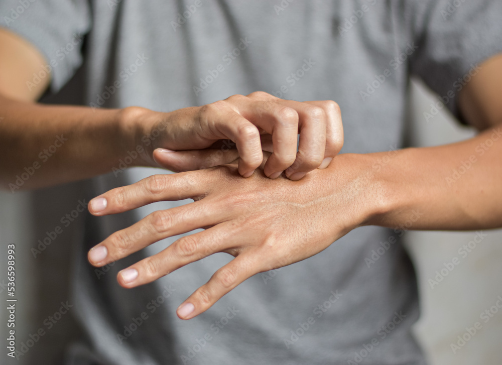 Asian man scratching his hand. Concept of itchy skin diseases such as scabies, fungal infection