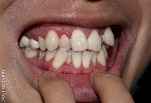 Tablou pe pânză Stacked or overlapping white teeth. Also called crowded teeth.