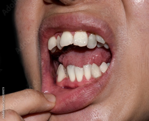 Stacked or overlapping white teeth. Also called crowded teeth.