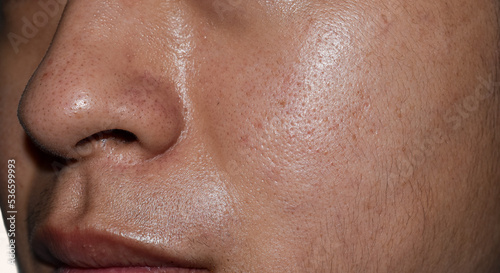 Oily face with wide pores of Southeast Asian, Myanmar or Korean adult man.