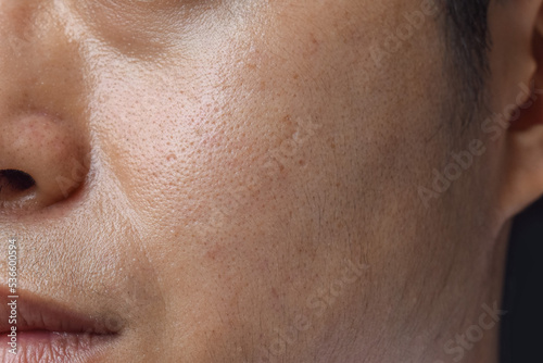 Fair skin with wide pores in face of Asian, Myanmar or Korean man. photo