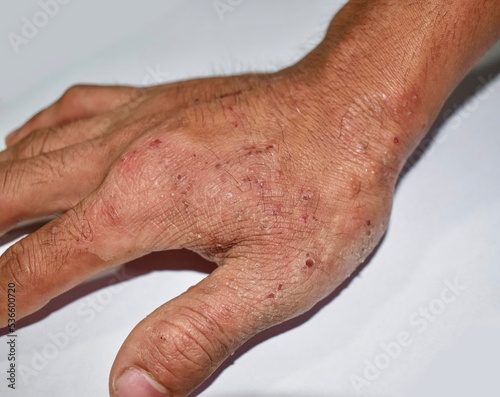 Tableau sur toile Itchy skin lesions in hand of Asian man