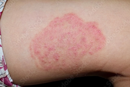 Fungal infection called tinea corporis in thigh of Asian child. Ringworm photo