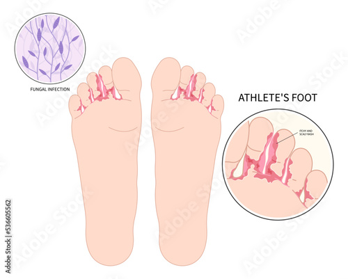 foot toe smell bad of Athlete's with Itchiness and jock itch symptom pus fungus bacteria