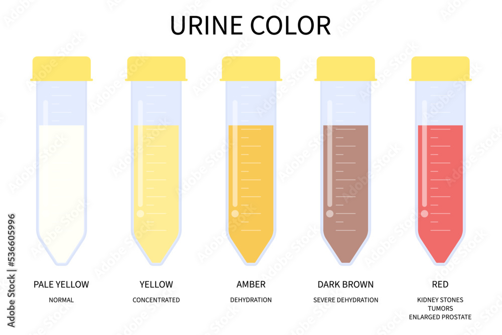 pee-color-after-dialysis-transplant-microscopic-urination-diagnostic