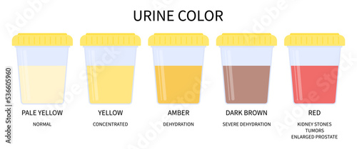 color of urination microscopic diagnostic exam the renal calculi stone cancer tumor gland and painful Sickle cell anemia test pee dialysis transplant