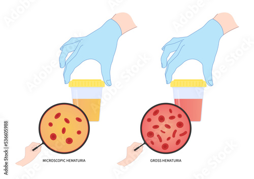 Sickle cell anemia test and color pee with microscopic urination diagnostic exam renal calculi stone painful cancer tumor gland dialysis transplant photo