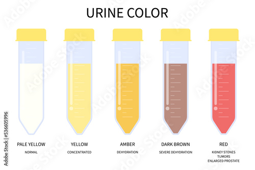 pee color after dialysis transplant microscopic urination diagnostic exam renal calculi stone cancer tumor painful gland Sickle cell anemia test